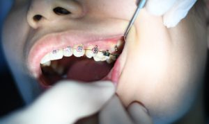 A closeup of a dentist working on someone's braced teeth with an instrument