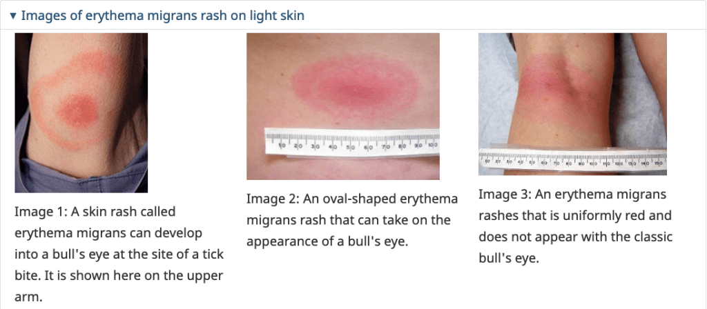 Images of “erythema migrans” or bulls’-eye rash, which is a symptom of Lyme disease on light skin, from Health Canada’s website on Lyme disease