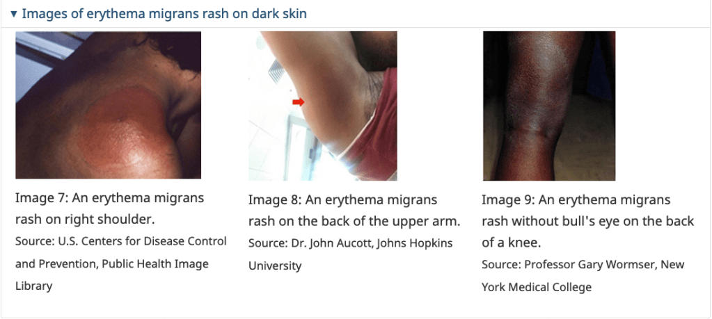 Images of the “erythema migrans” bulls’-eye rash, which is a symptom of Lyme disease on dark skin, from Health Canada’s website on Lyme disease